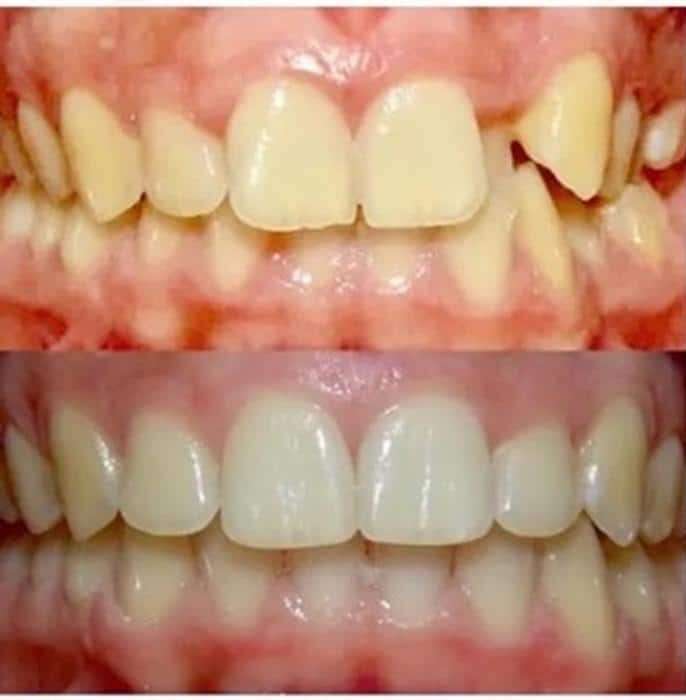 Invisalign 13 Months Before and After