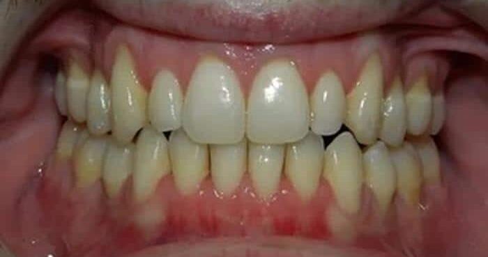 Invisalign 18 months 4 Premolar Extraction - After