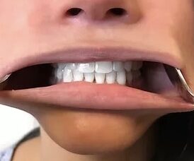 overbite