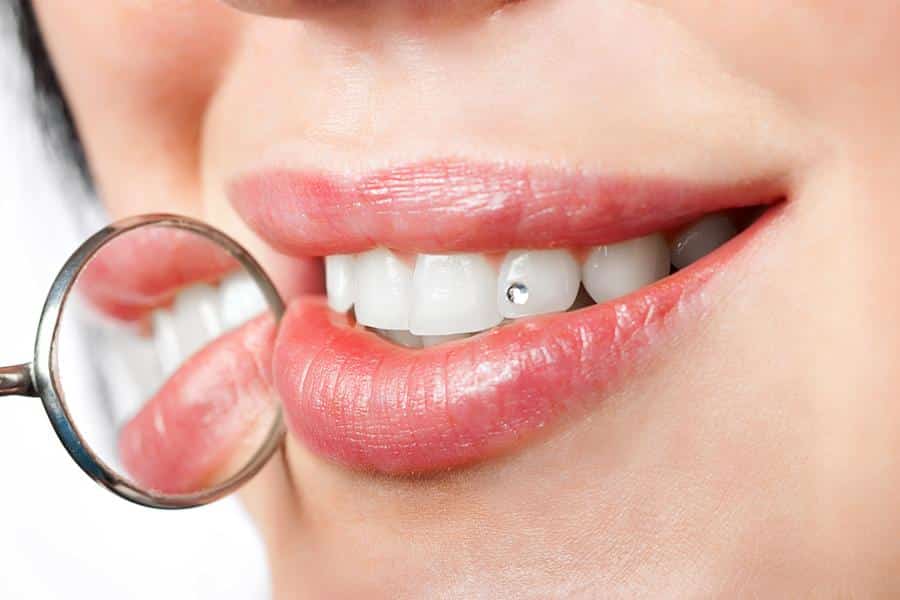Tooth Gems - Clemente Orthodontics