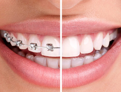 Traditional Braces vs. Invisalign: Which is Right for You?