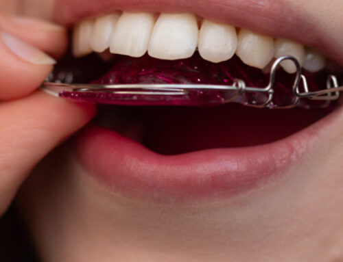 The Importance of Retainers After Braces: How to Keep Your Smile Perfect