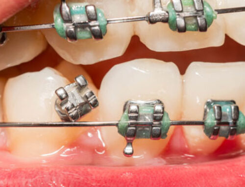 What to Do if Your Braces Break or Get Damaged