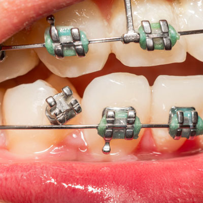 broken braces