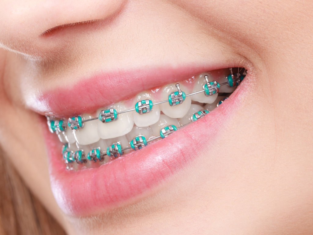 Closeup of woman teeth with braces Airways and Orthodontics