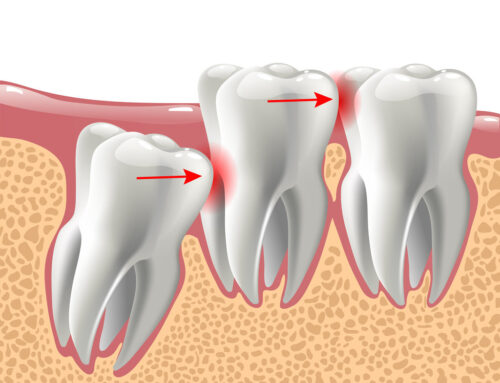 Treating Orthodontic Issues Following Wisdom Teeth Removal