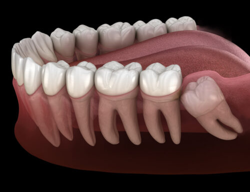 Do You Need Orthodontic Treatment After Wisdom Tooth Extraction?