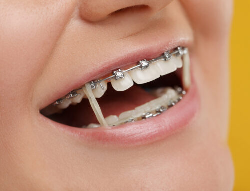 Orthodontic Elastics: How Rubber Bands Move Your Teeth