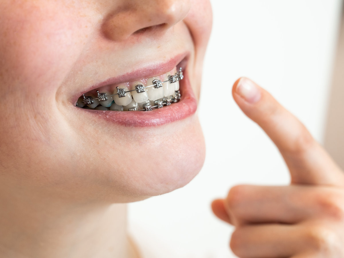 Close-up portrait of a young woman pointing at a smile with braces on her teeth. Close-up portrait of a young woman pointing at a smile with braces on her teeth