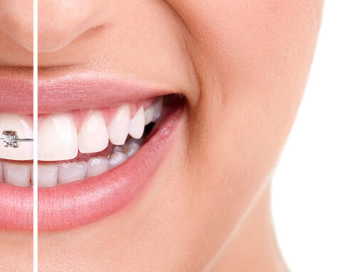 Braces vs Invisalign® Cost Comparison: Which is More Affordable