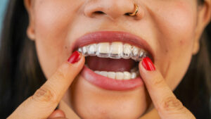 Young Asian Indian woman holding removable invisible aligner, also known as invisalign or clear aligner