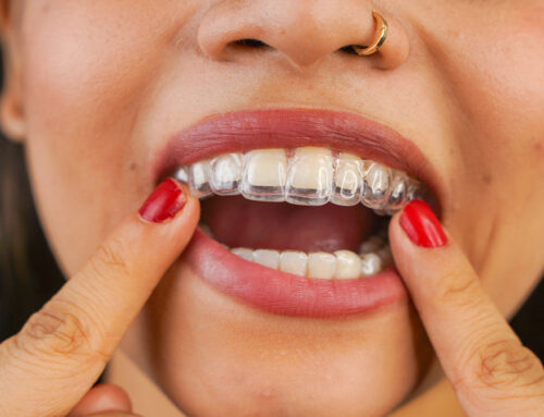 The Truth About Invisalign® Attachments: Why 90% Attachment-Free Treatment Matters
