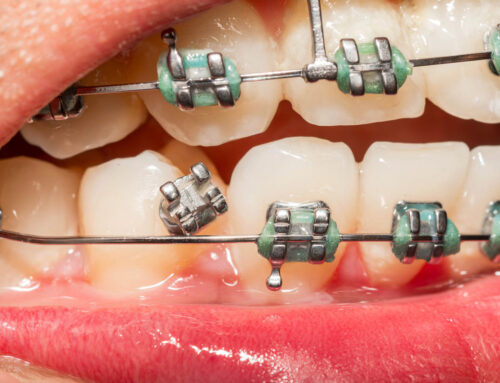 How to Deal With Orthodontic Emergencies During the Holidays