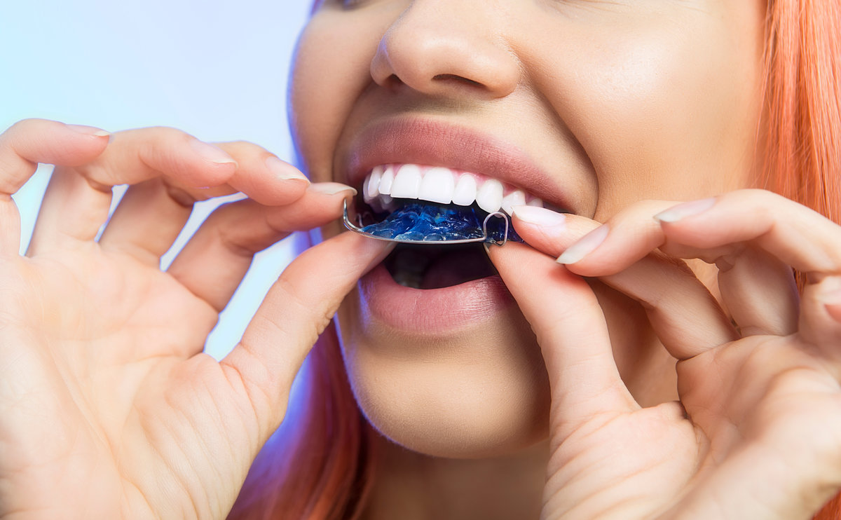 Smiling Girl with Retainer for Teeth, Close-up Smiling Girl Holding blue Retainer, Braces for Teeth. Orthodontics Dental Theme, Methods of Teeth (Bite) Correction, Close-up