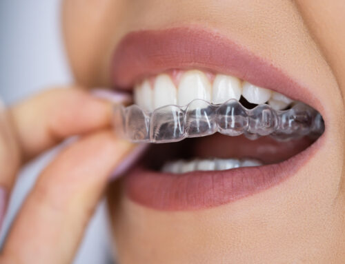 Invisalign Refinements®: When Your First Set of Aligners Isn’t Enough
