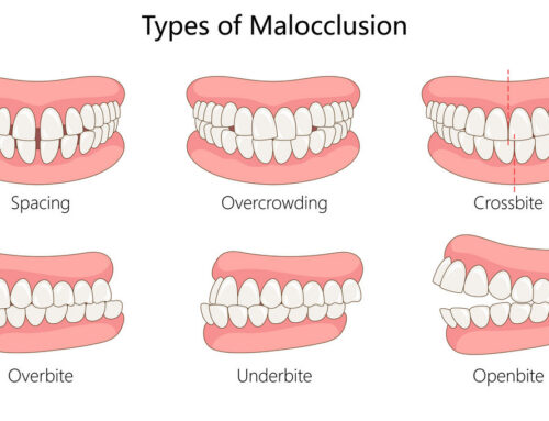 Understanding Overbites, Underbites, and Crossbites: Which Do You Have?