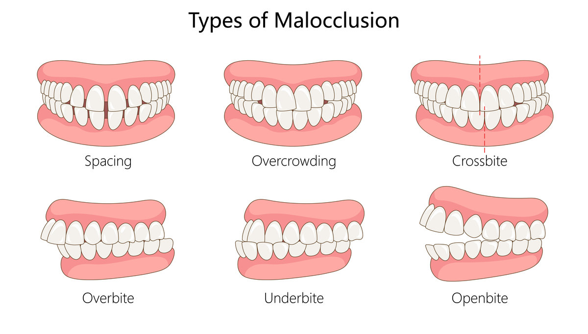 types of malocclusion, including spacing, overcrowding, crossbite, overbite, underbite, and open bite diagram hand drawn schematic vector illustration. Medical science educational illustration