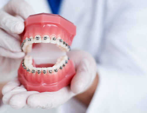 Preparing for Your Braces: What to Buy and How to Get Ready