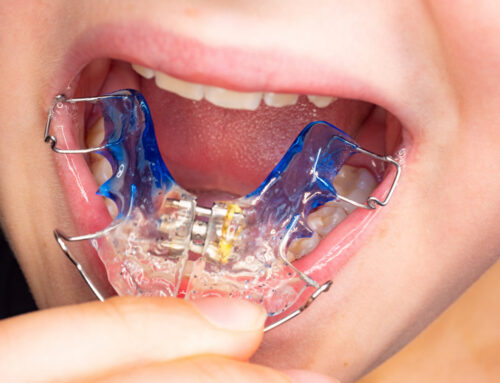 The Role of Palate Expanders in Early Orthodontic Treatment