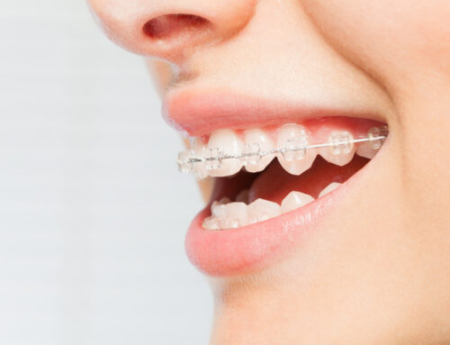 The Different Stages of Braces Wires: What Each One Does and Why It Matters