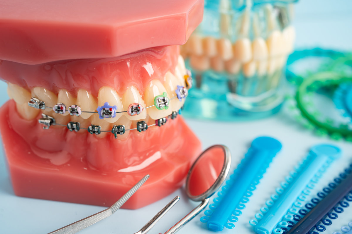Orthodontic ligatures rings and ties, elastic rubber bands on orthodontic braces, model for dentist studying about dentistry.
