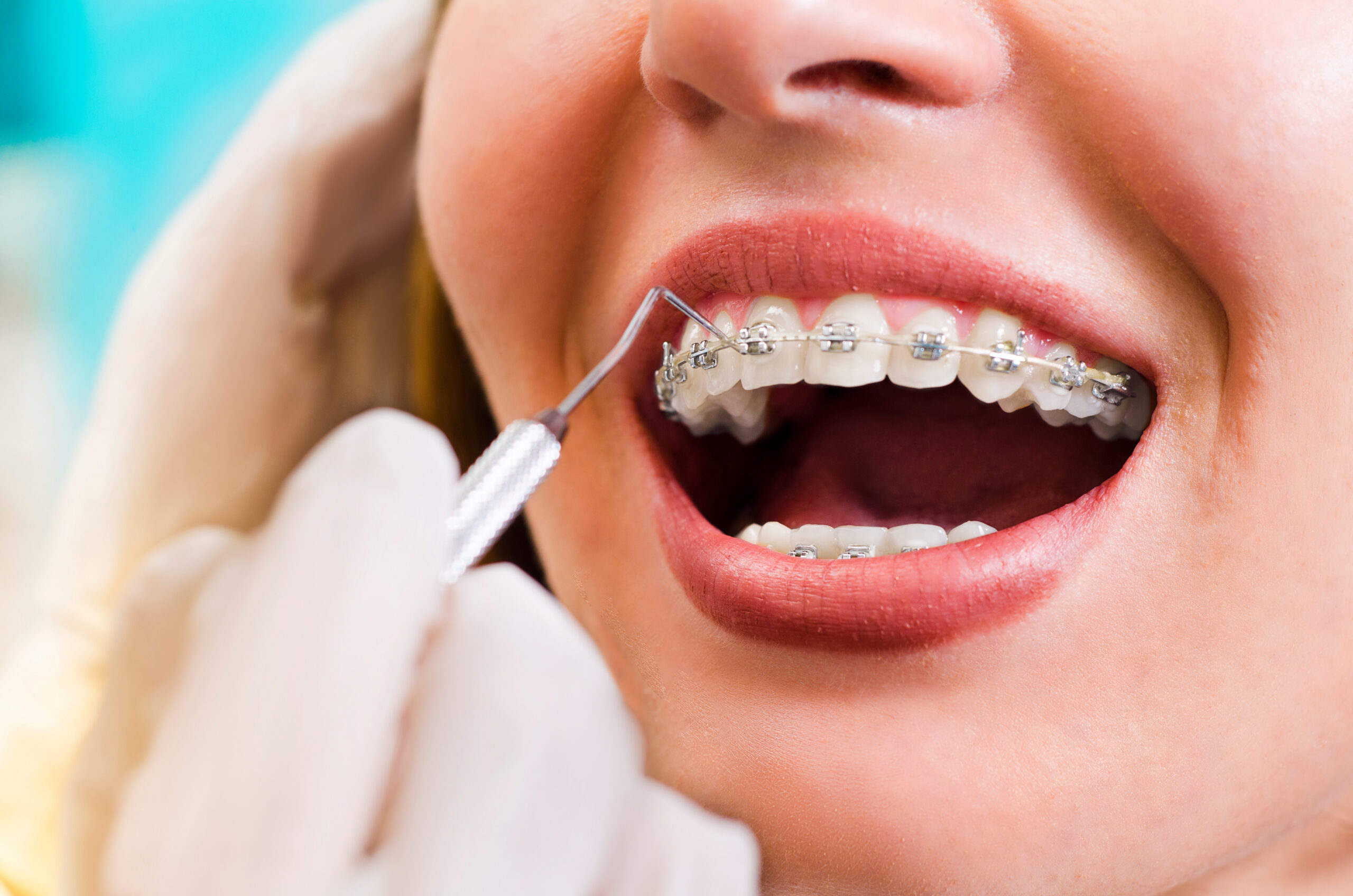 Closeup young woman checking her braces, smiling Closeup young woman checking her braces, smiling
