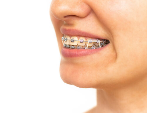 Overbite Rubber Bands: How Elastics Correct Bite Problems