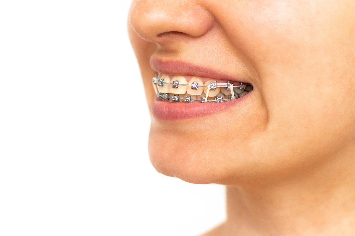 Closeup of woman with braces on teeth with elastics. Smiling face with braces isolated on white background. Orthodontic treatment. Closeup of healthy female mouth with metal braces.