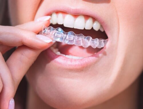 How to Keep Your Invisalign® Trays From Staining